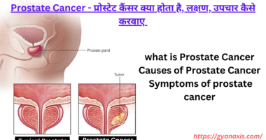 what is Prostate Cancer,treatment,types