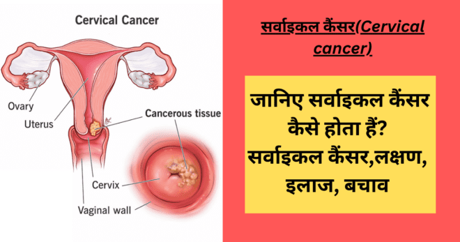 सर्वाइकल कैंसर Cervical cancer symtoms,treatment,causes